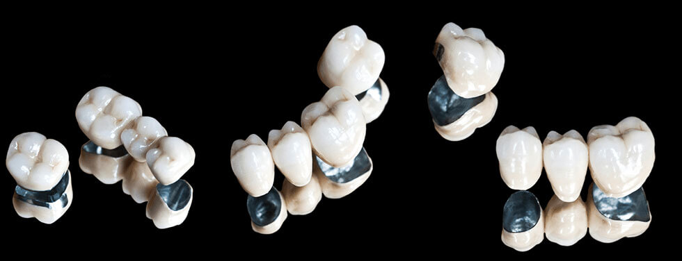 Hình ảnh răng sứ kim loại