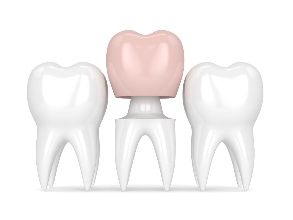 Trồng răng sứ răng giả giúp phục hồi răng mất