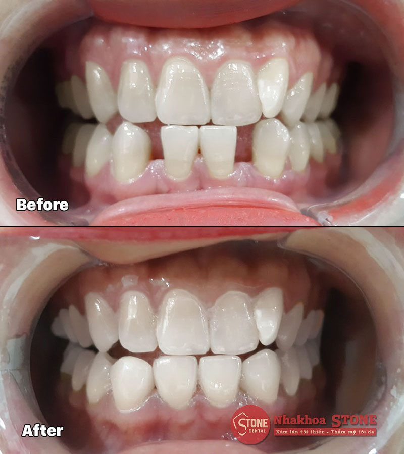 điều trị răng thưa hiệu quả bằng mặt dán sứ veneer