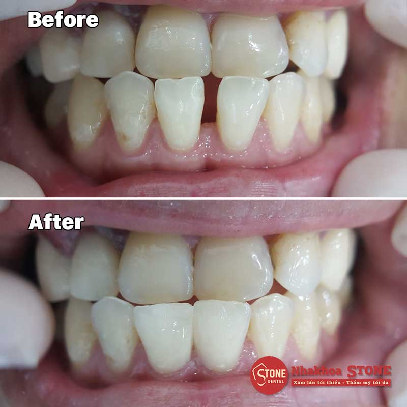04 phương pháp điều trị răng thưa hiệu quả  nha khoa stone