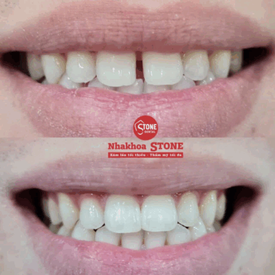 Kết quả trám răng thẩm mỹ bằng Composite tại Nha khoa Stone