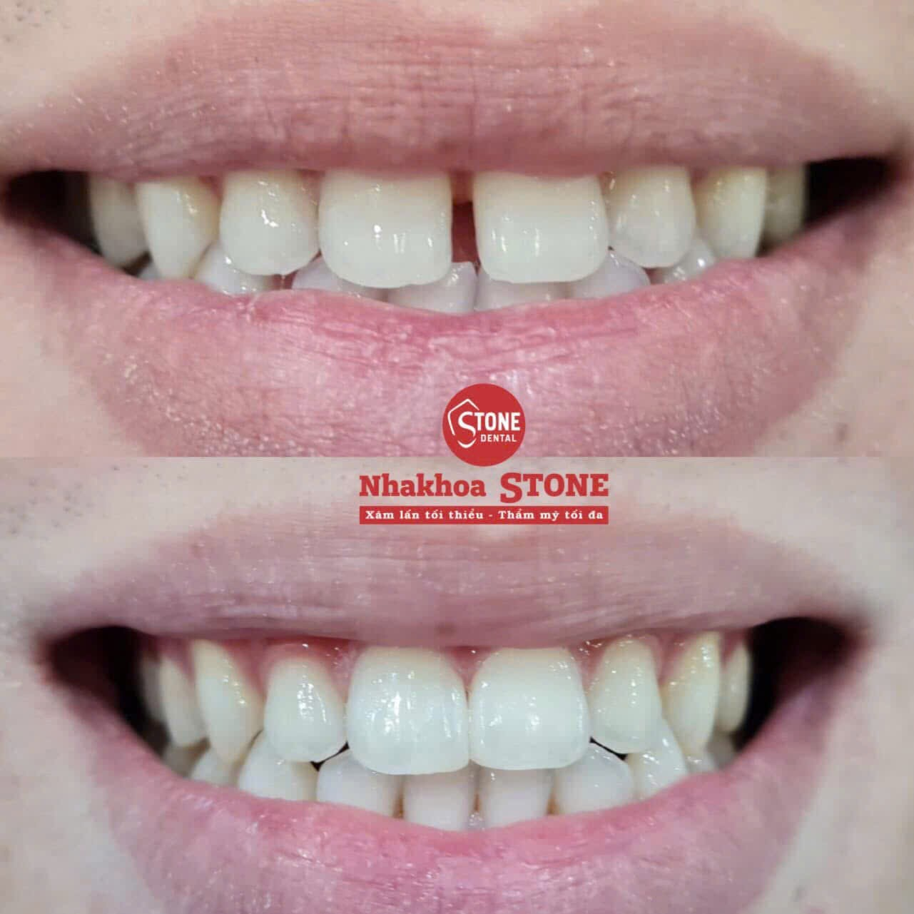 Kết quả trám răng thẩm mỹ bằng Composite tại Nha khoa Stone