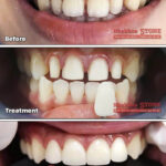 Nụ cười tự nhiên của khách hàng sau khi phục hình răng cố định tại Nha khoa Stone