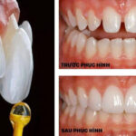 Dán sứ Veneer cho răng thưa mẻ giúp bảo tồn răng thật