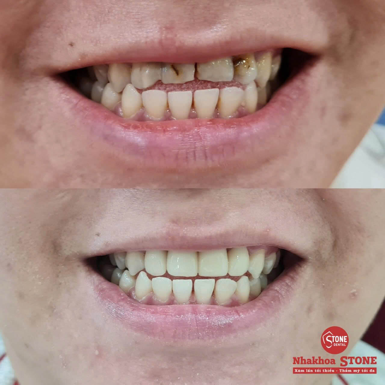 Phục hình răng sứ thẩm mỹ cho răng xỉn màu và khấp khểnh tại Nha khoa Stone