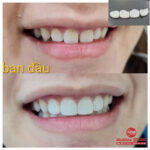 Kết quả dán sứ Veneer thẩm mỹ cho răng thưa tại Nha khoa Stone