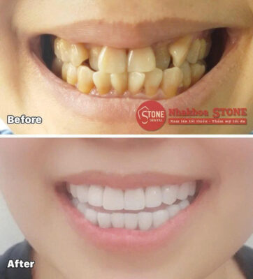 Phục hình răng sứ thẩm mỹ cho răng xỉn màu và khấp khểnh tại Nha khoa Stone