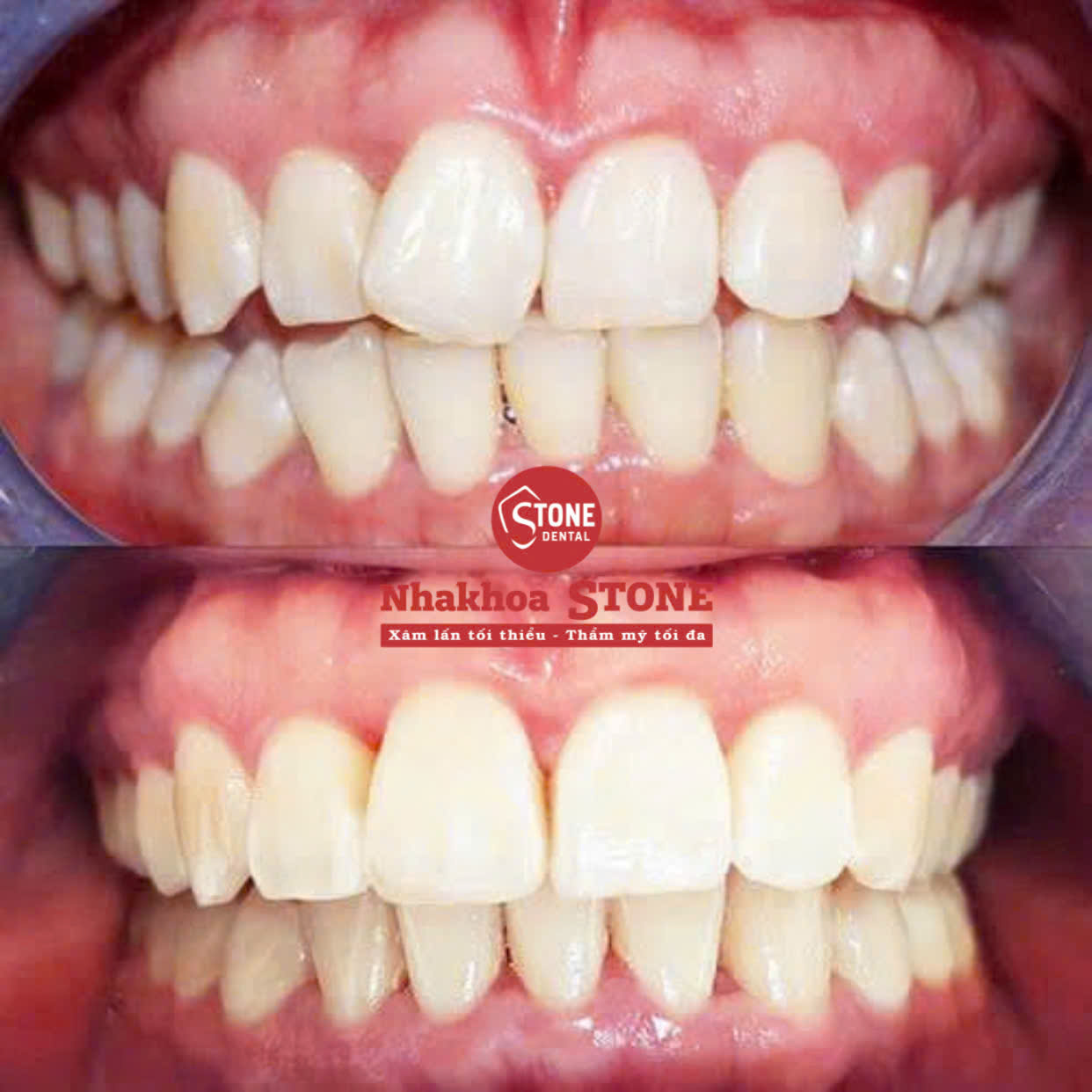 Kết quả bọc răng sứ chỉnh răng bị lệch tại Nha khoa Stone