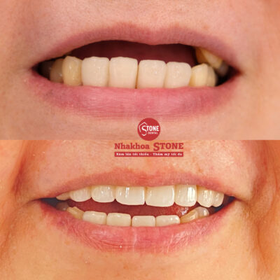 Kết quả phục hình cầu răng sứ thẩm mỹ cho khách hàng mất răng tại Nha khoa Stone