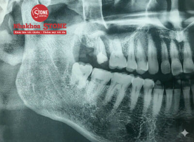 Kết quả chụp phim X-quang răng khôn mọc thẳng gây viêm sưng tại Nha Khoa Stone