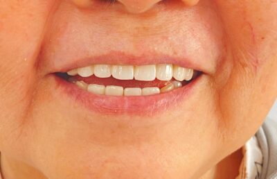 ket qua phuc hinh cau rang su tham my dep tu nhien tai nha khoa stone