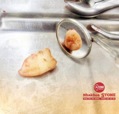 🦷 Răng khôn là gì? Khi nào nên nhổ răng khôn?