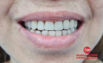 Kết quả phục hình răng giả tháo lắp thẩm mỹ tại Nha khoa Stone.