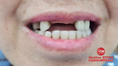 Tình trạng mất răng cửa ở người lớn tuổi cần làm răng giả tháo lắp.