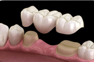 mo hinh phuc hinh cau rang su