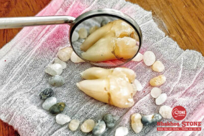 ận cảnh chiếc răng khôn mọc lệch vừa được bác sĩ tại Nha khoa Stone nhổ bỏ nhẹ nhàng, không gây đau đớn.