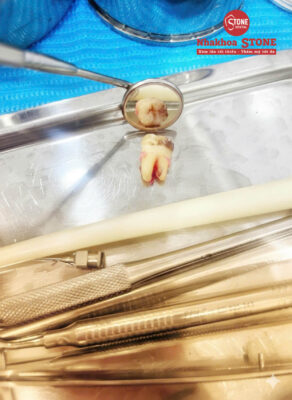 Nhổ răng khôn.Tại sao răng khôn mọc thẳng vẫn đau nhức- Nha Khoa Stone