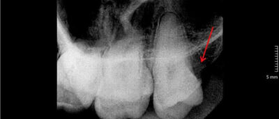 phim x-quang rang khon ham tren nha khoa stone.