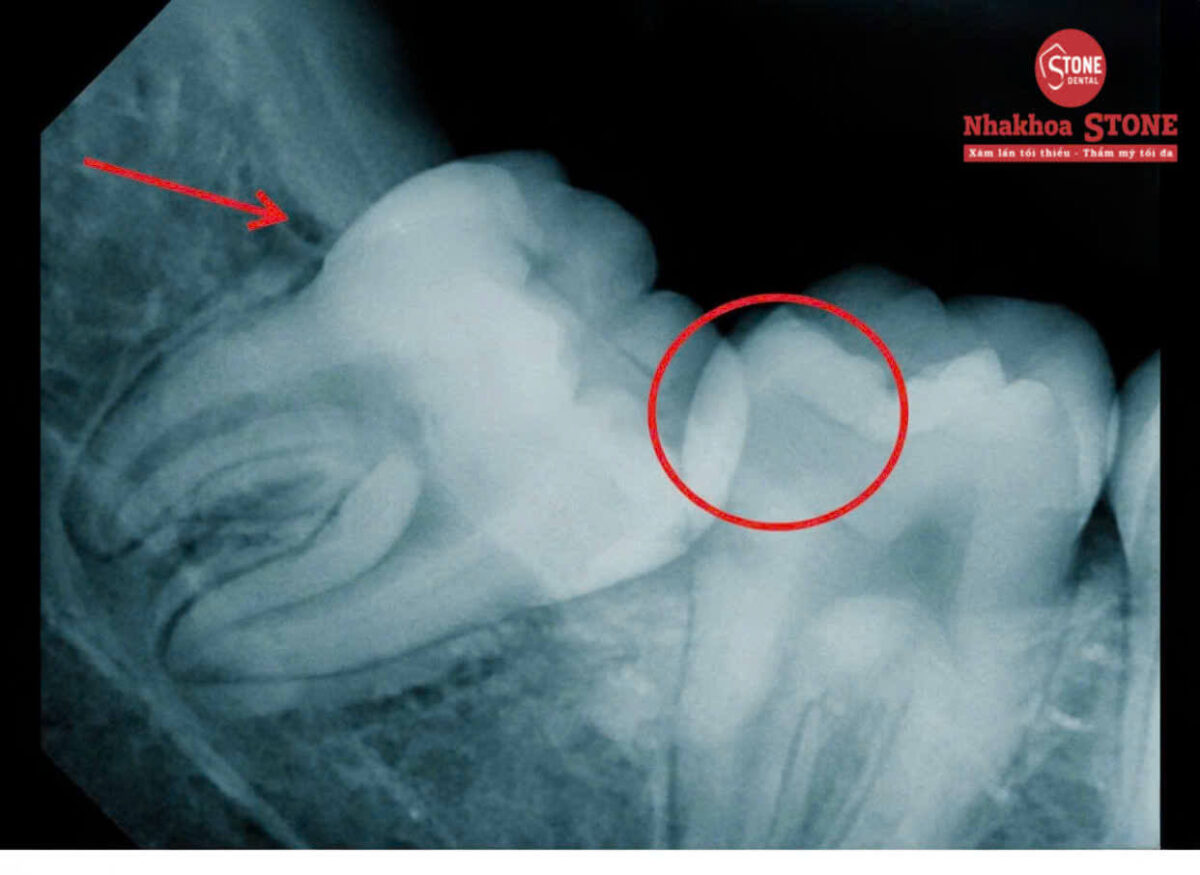 Hình ảnh X-quang răng khôn mọc ngầm đâm vào răng số 7 tại Nha khoa Stone.