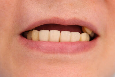 tinh trang mat rang truoc khi lam cau rang su