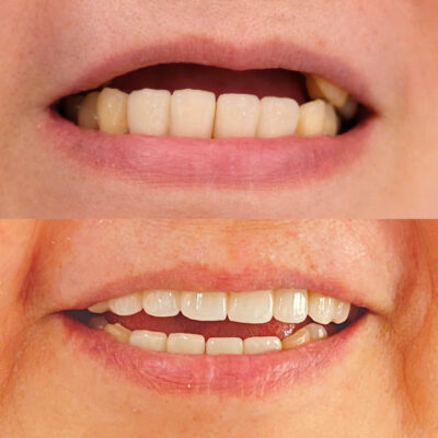 Cầu Răng Sứ: Giải Pháp Phục Hồi Răng Mất Nhanh Chóng & Hiệu Quả Tại Nha Khoa Stone