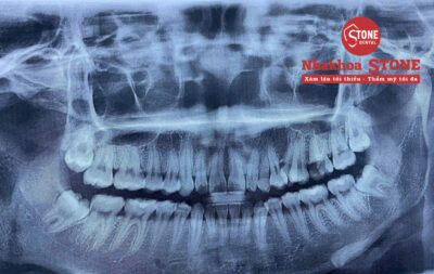 Phim X-quang răng khôn tại Nha Khoa Stone
