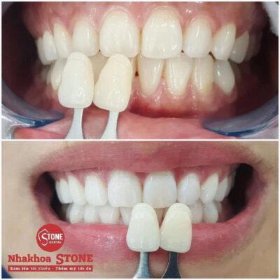 Kết quả so sánh trước và sau khi tẩy trắng răng thẩm mỹ tại Nha Khoa Stone