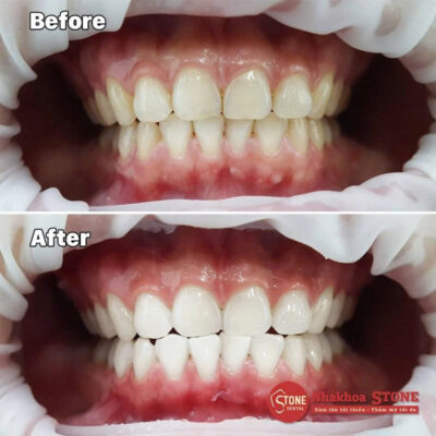 Hình ảnh so sánh kết quả trước và sau khi tẩy trắng răng tại Nha Khoa Stone