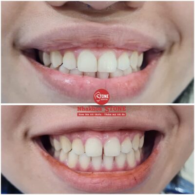So sánh trước và sau khi trám răng thẩm mỹ tại Nha Khoa Stone